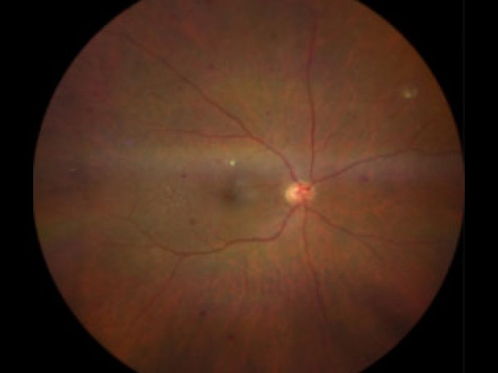 Diabetes y los ojos